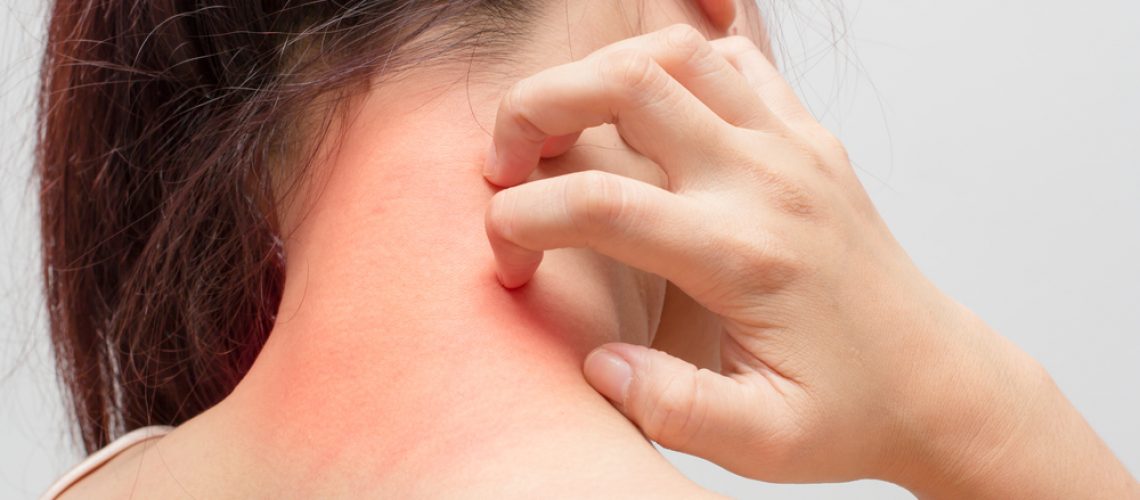 Alergias na pele como identificar e tratar